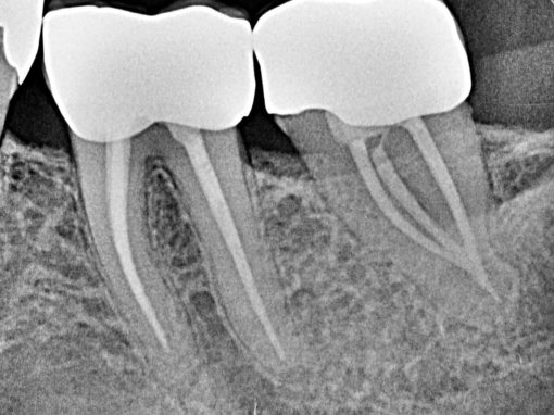 Endodontie Wurzelkanalbehandlung